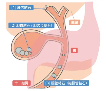 【稲沢市】胆石症の原因と予防法